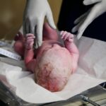 Cesarskie cięcie zagrożenia – poznaj kluczowe ryzyka 87